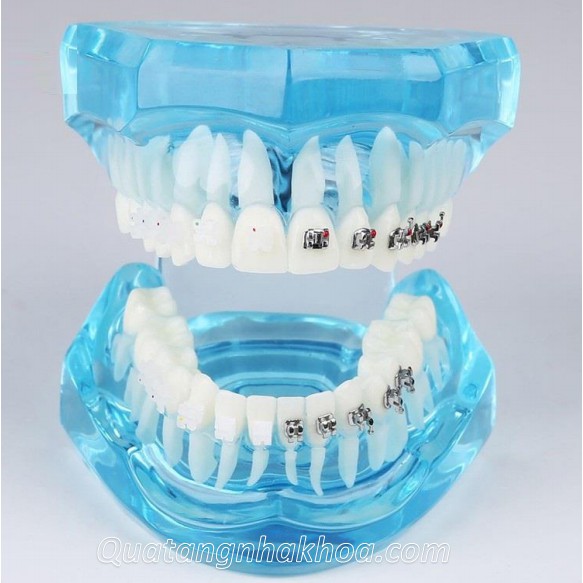 Mẫu hàm tư vấn so sánh chỉnh nha mắc cài kim loại và mắc cài sứ – mô hình nắn chỉnh răng nha khoa