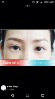 kích mí lưới