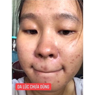 Tri Mụn Thâm Dr Mai