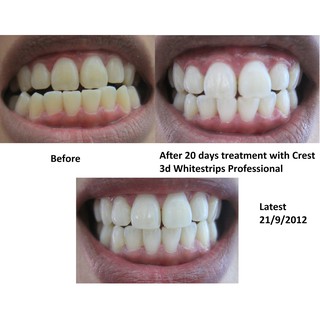 Miếng dán trắng răng Crest 3D Professional Effects hàng Mỹ