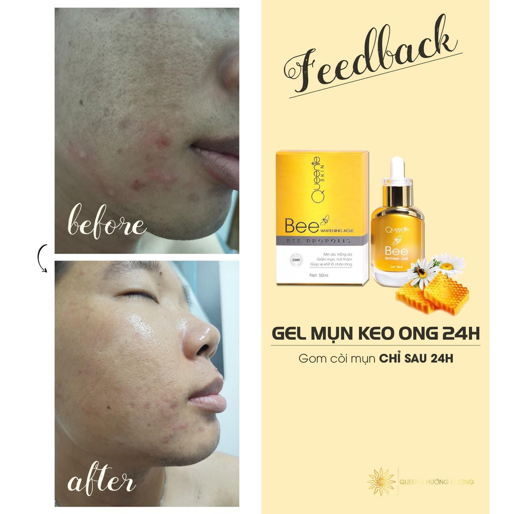 GEL MỤN KEO ONG | BigBuy360 - bigbuy360.vn