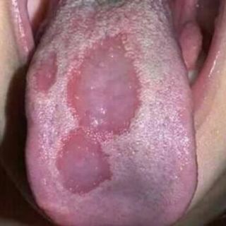 Trị NẤM LƯỠI, NẤM BẢN ĐỒ và các bệnh RĂNG MIỆNG