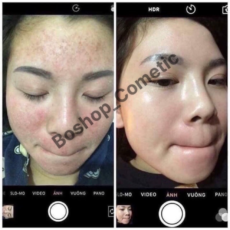 Mộc    Tuyết Sự Lựa Chọn Hoàn Hảo Dành Cho Da mụn Thâm | BigBuy360 - bigbuy360.vn