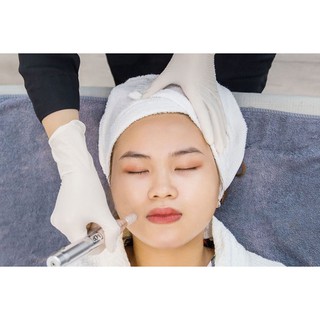 Cấy chỉ tơ tằm Chitossil Hàn Quốc