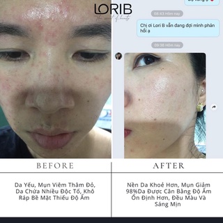 Kem Mụn Thảo dược Lori B