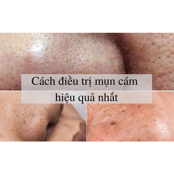 Gel lô hội giảm mụn Nga