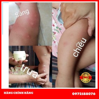 { Quà Cho Con} Kem Muỗi Làm Dịu Và Phục Hồi Da