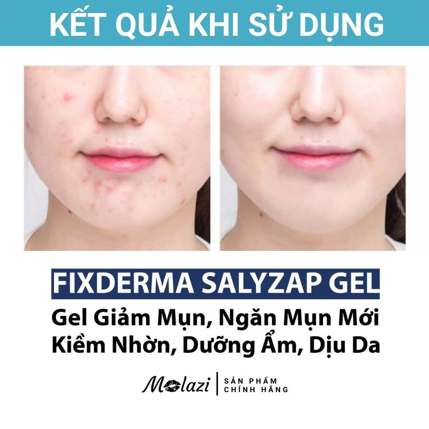 Kem chấm mụn Fixderma Salyzap giảm ngừa mụn dưỡng ẩm tái tạo dưỡng trắng phục hồi da mờ thâm (gel chấm mụn 20gr) molazi. | BigBuy360 - bigbuy360.vn