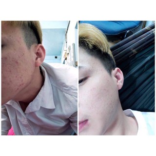 [Beman123] CAO MỤN SÂM ĐỎ FULLBOX 15GR