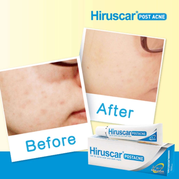 Hiruscar Post Acne 10G - Gel Làm Mờ Sẹo Mụn Và Thâm Mụn