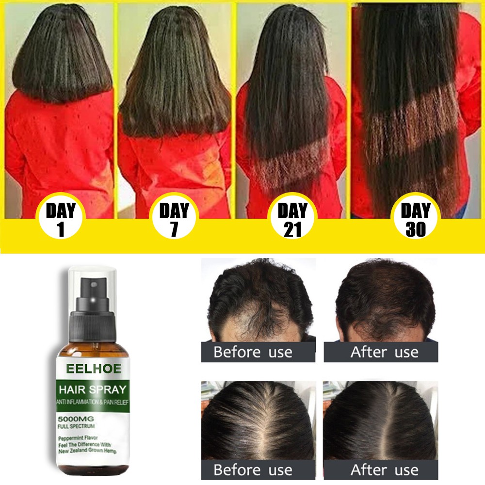 (Hàng Mới Về) Chai Xịt Kích Thích Mọc Tóc Và Trị Hói Đầu Hiệu Quả | BigBuy360 - bigbuy360.vn