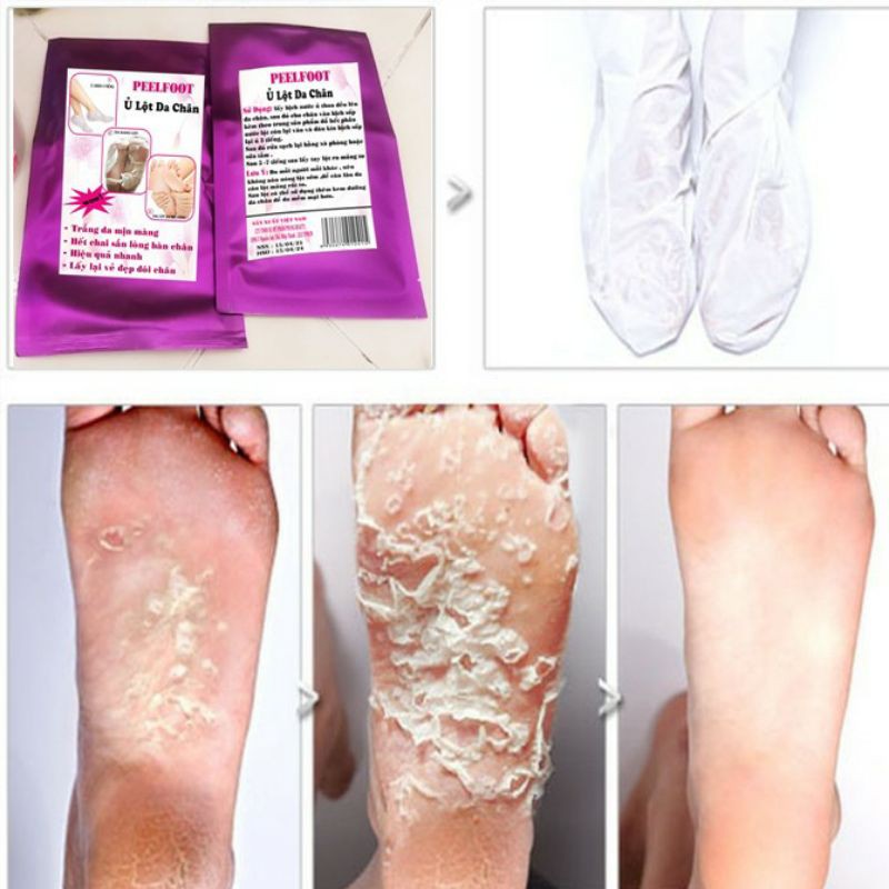Ủ Lột Da Chân Hết Chai Sần Trắng Da
