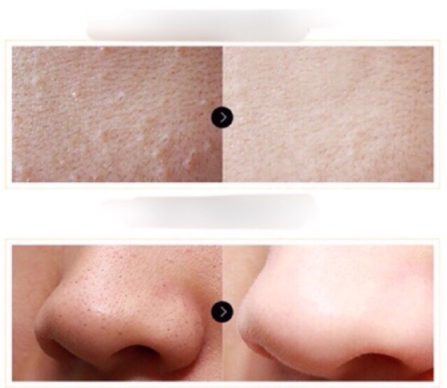 Serum Shrinkage Pore