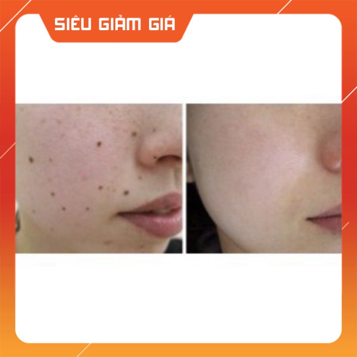 Gel Dvelinil Chấm Tẩy Nốt Ruồi Tàn Nhang Nga 3ML