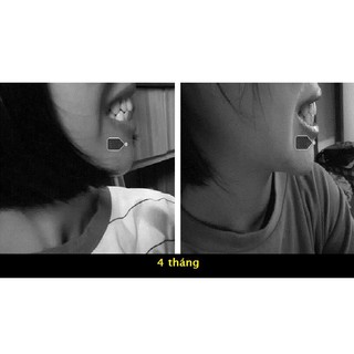 Bộ Dụng Cụ Niềng Răng Tại Nhà ( 3 giai đoạn )