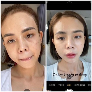 (Mẫu mới ) serum mụn Lumos hàng công ty 5ml