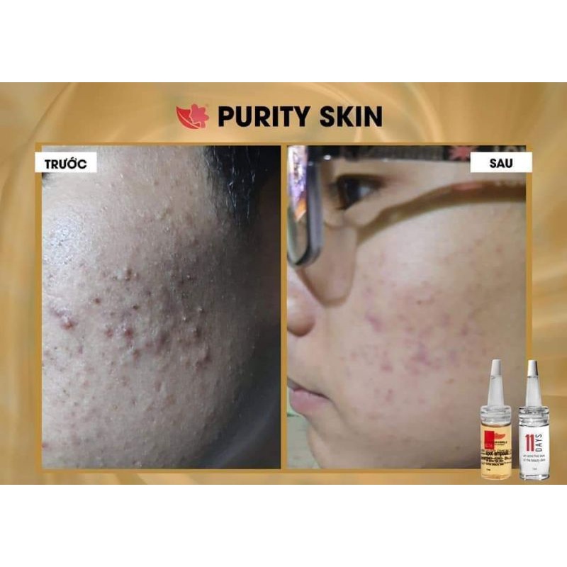 [CHÍNH HÃNG] BỘ GIẢM MỤN, NGỪA MỤN PURITY SKIN mua kèm Nước Tẩy Trang | BigBuy360 - bigbuy360.vn