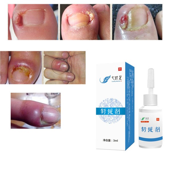 (Hàng Mới Về) Thuốc Mỡ Trị Nấm Móng An Toàn Và Hiệu Quả | BigBuy360 - bigbuy360.vn