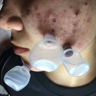 10 Ống nhựa hút máu bầm khi nặn mụn