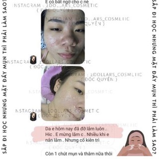 Huyền Dịch Giảm Mụn Cấp Tốc BOLTUSHKA