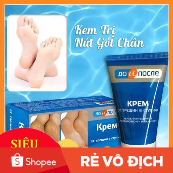 Kem trị nứt nẻ gót chân Nga