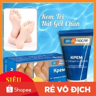 Kem trị nứt nẻ gót chân Nga