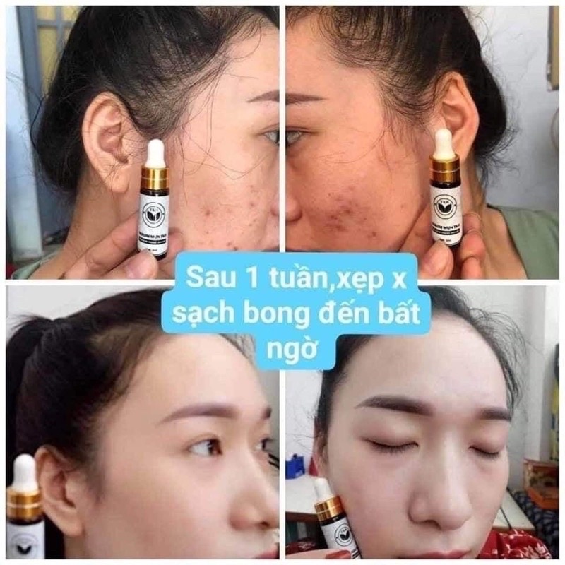 SERUM GIẢM THÂM MỤN TRẦN KIM HUYỀN