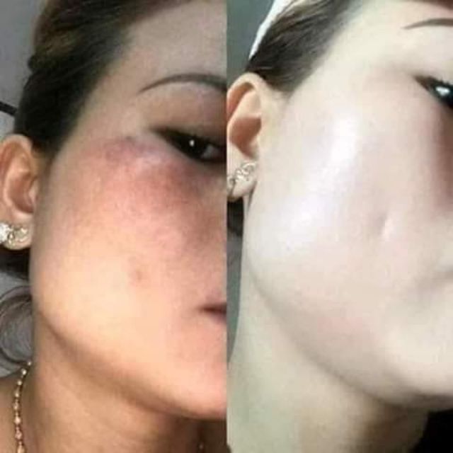 COMBO 10 HỘP CAO CẤP CLOBETAMIL G