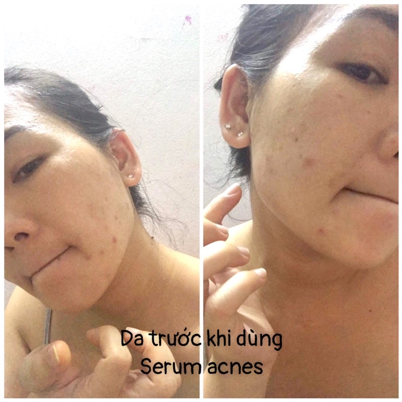 Serum  Kyung Lab Acnes Centella Asiatica Ampoule 50ml kiềm dầu mờ thâm