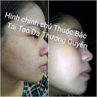 Combo (thuốc 2 tháng, dưỡng 1 tháng sau tt, bột rửa, hồng da) THUỐC BẮC TÁI TẠO DA