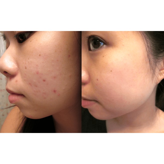 ✔️[100% Chính Hãng] Kem Xóa Thâm Mờ Dạn Chiết Xuất Dầu Cá Mờ Thâm, Tái Tạo Làn Da | BigBuy360 - bigbuy360.vn