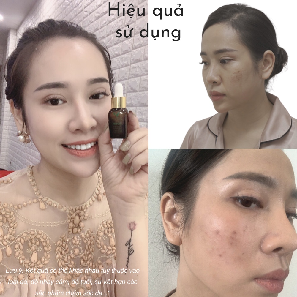 Serum mờ thâm nám tàn nhang trắng da, mỹ phẩm cho bà bầu V9Queen an toàn hiệu quả