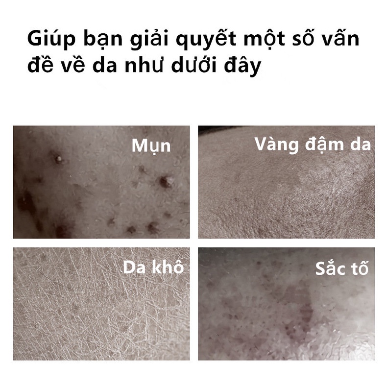 Venzen Gel Hỗ trợ giảm mụn Và Tàn Nhang Dưỡng Ẩm Làm Sáng Da Dịu Nhẹ