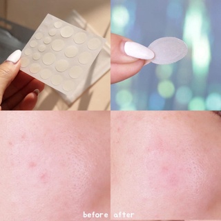 Miếng Dán Mụn Cosrx Acne pimple master Patch (24 miếng)