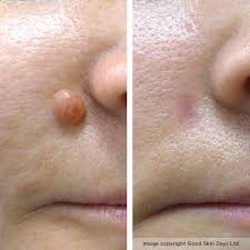 Kem tẩy nốt ruồi, sẹo lồi, mụn cóc hiệu quả | BigBuy360 - bigbuy360.vn