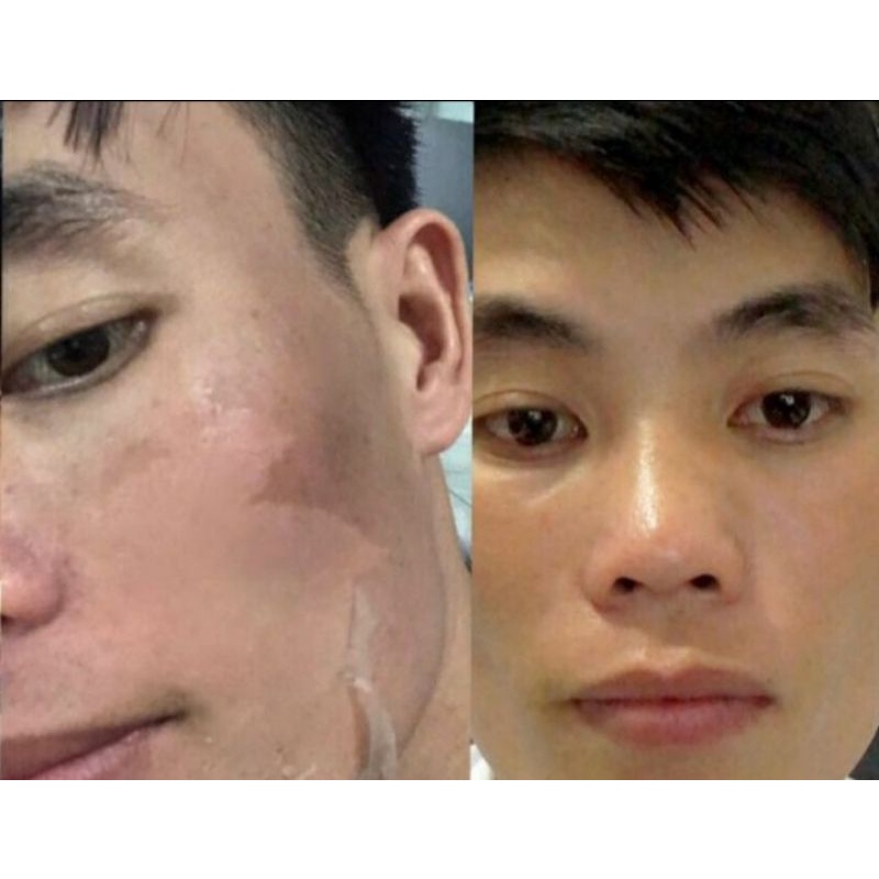 Lột Da Mặt Sinh Học BEZY Thái lan – mẫu mới 2022