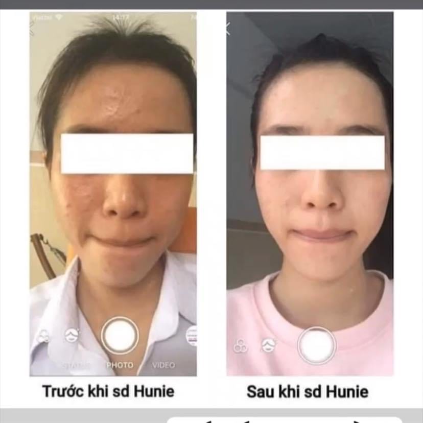 Combo trị mụn và trị thâm hunie