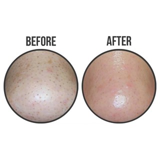 MIẾNG DÁN ĐẨY MỤN ĐẦU ĐEN ciracle goodbye blackhead Hàn Quốc
