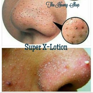 🇺🇸🇺🇸Ủ MỤN ĐẦU ĐEN ĐẦU TRẮNG SUPER X LOTION