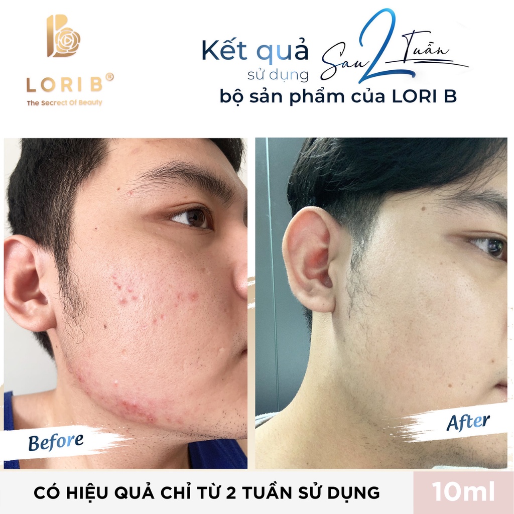 Combo Kem mụn, Kem Thâm Lori B