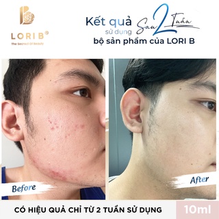 Combo Kem mụn, Sữa rửa mặt Lori B