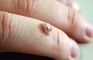 Mụn cơm, mụn cóc, mắt cá