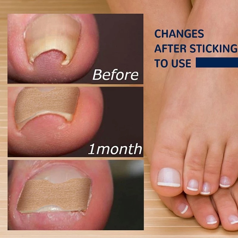 [Better For You] Miếng Dán Chỉnh Sửa Ngón Chân Không Dệt Co Giãn Chỉnh Sửa Chống Nước Thoáng Khí
