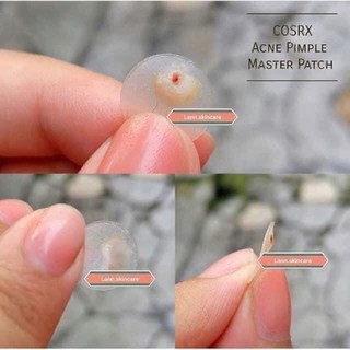 Miếng dán mụn Cosrx Acne Pimple Master Patch
