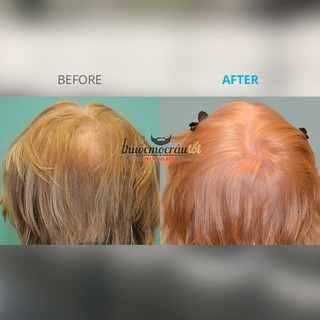 Thuốc mọc tóc Minoxidil 5% cho Nữ