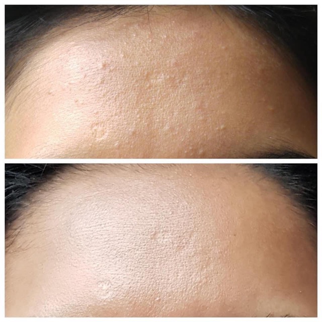 [Có Bill] Tinh chất Tẩy Tế Bào Chết - Cấp Nước The Ordinary Serum - Lactic Acid 5%+ HA 2% / Lactic Acid 10%+ HA 2%