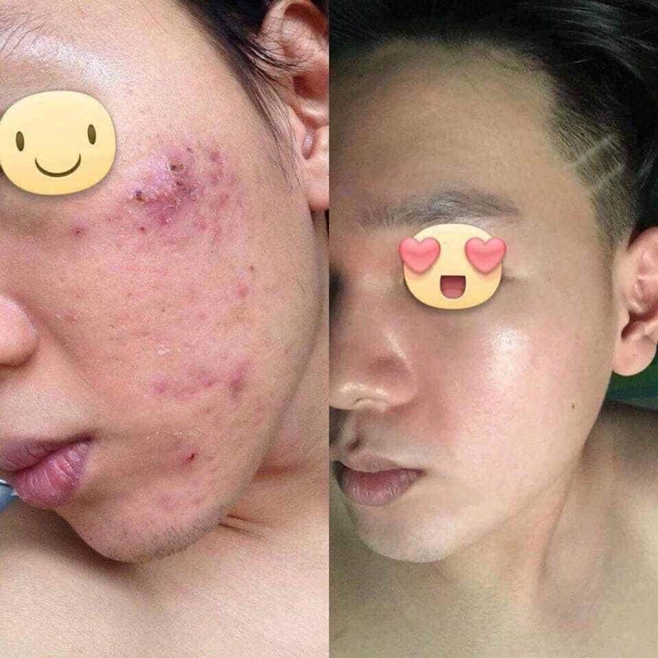 [FREESHIP] [CHÍNH HÃNG] Kem Mụn Thảo Dược Hoa Đào 2 weeks1 | BigBuy360 - bigbuy360.vn