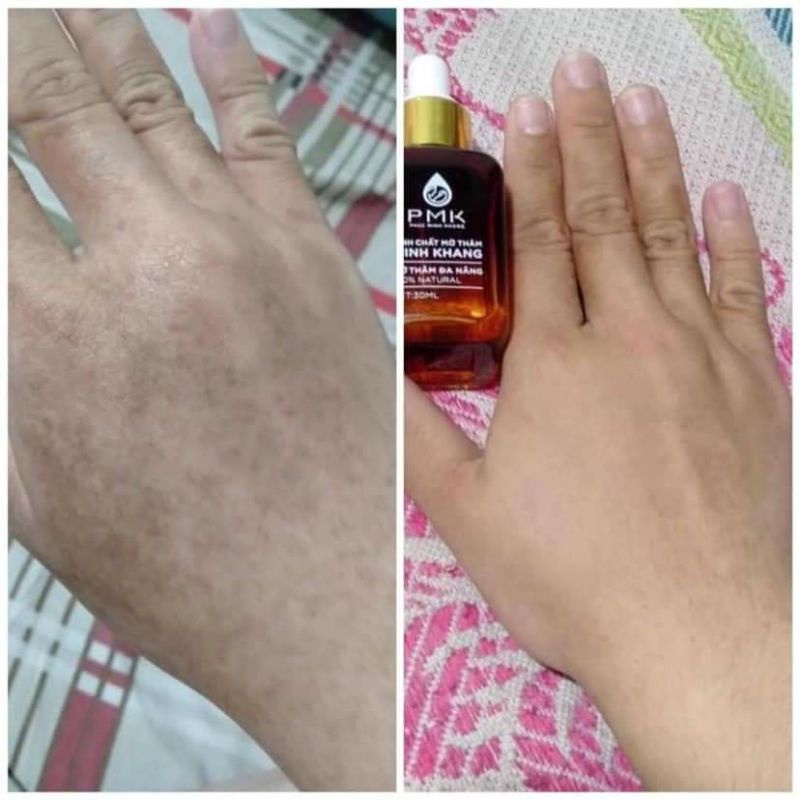 Tinh chất Xóa mờ thâm Minh Khang, Xoá thâm Sẹo,thâm mắt, thâm môi,thâm nách,thâm mụn - Chính Hãng