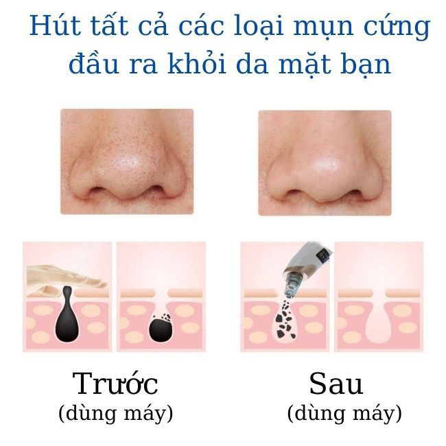 Máy hút mụn|Máy hút mụn đầu đen,mụn cám siêu sạch,siêu mạnh  Blackhead instrument | BigBuy360 - bigbuy360.vn
