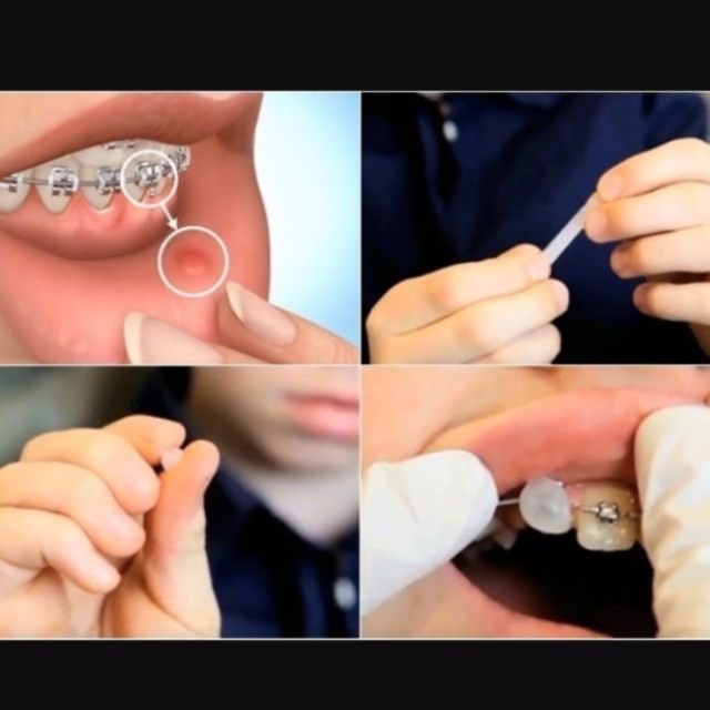 Sáp chỉnh nha giúp giảm đau GAC của hãng Dentsply Sirona – Mỹ, hộp 5 thanh màu trong | BigBuy360 - bigbuy360.vn
